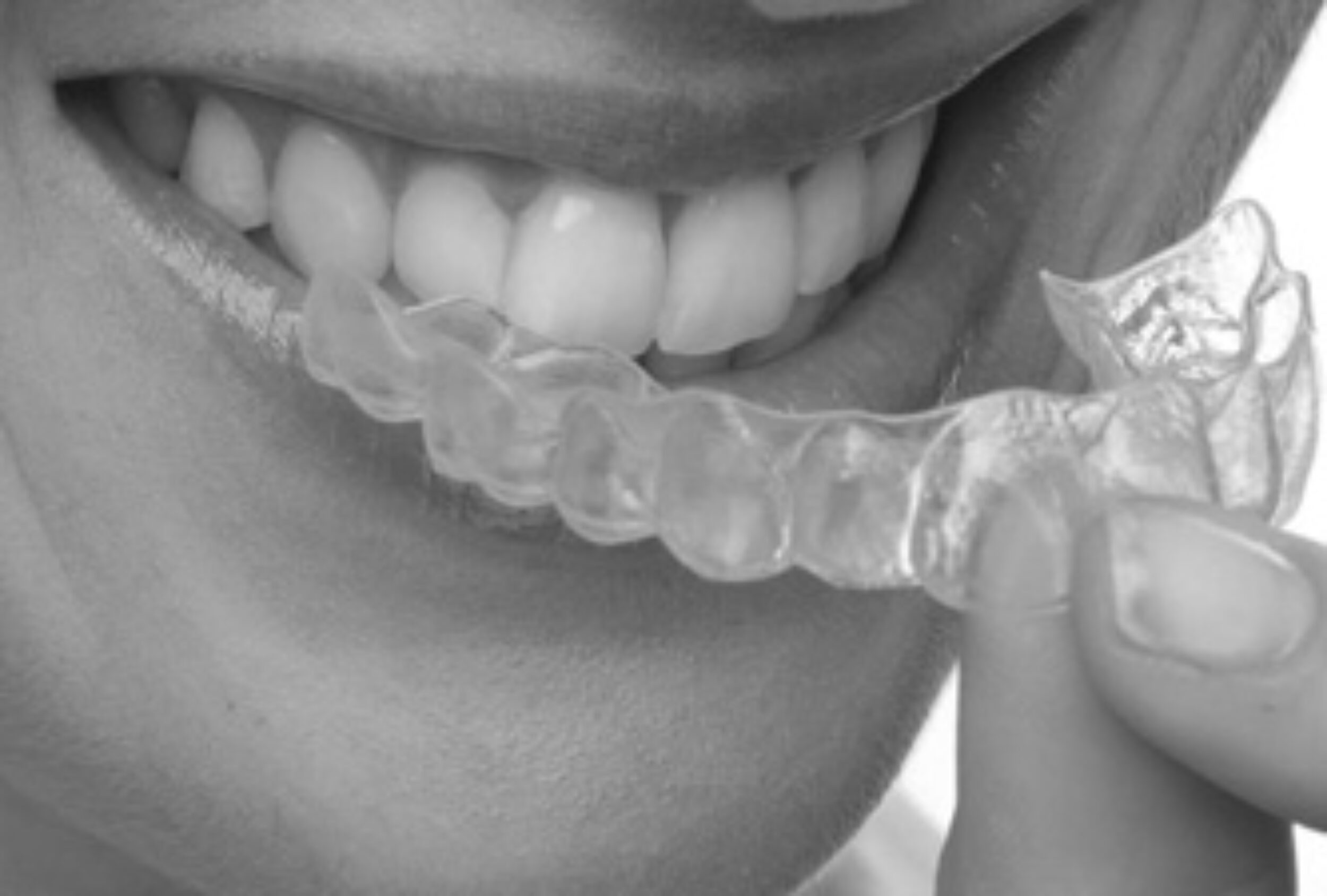 Invisalign Orthodontic Dental Treatment and Services