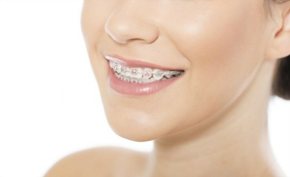 Do Braces Hurt When You Get Them Off and When Tightened? The