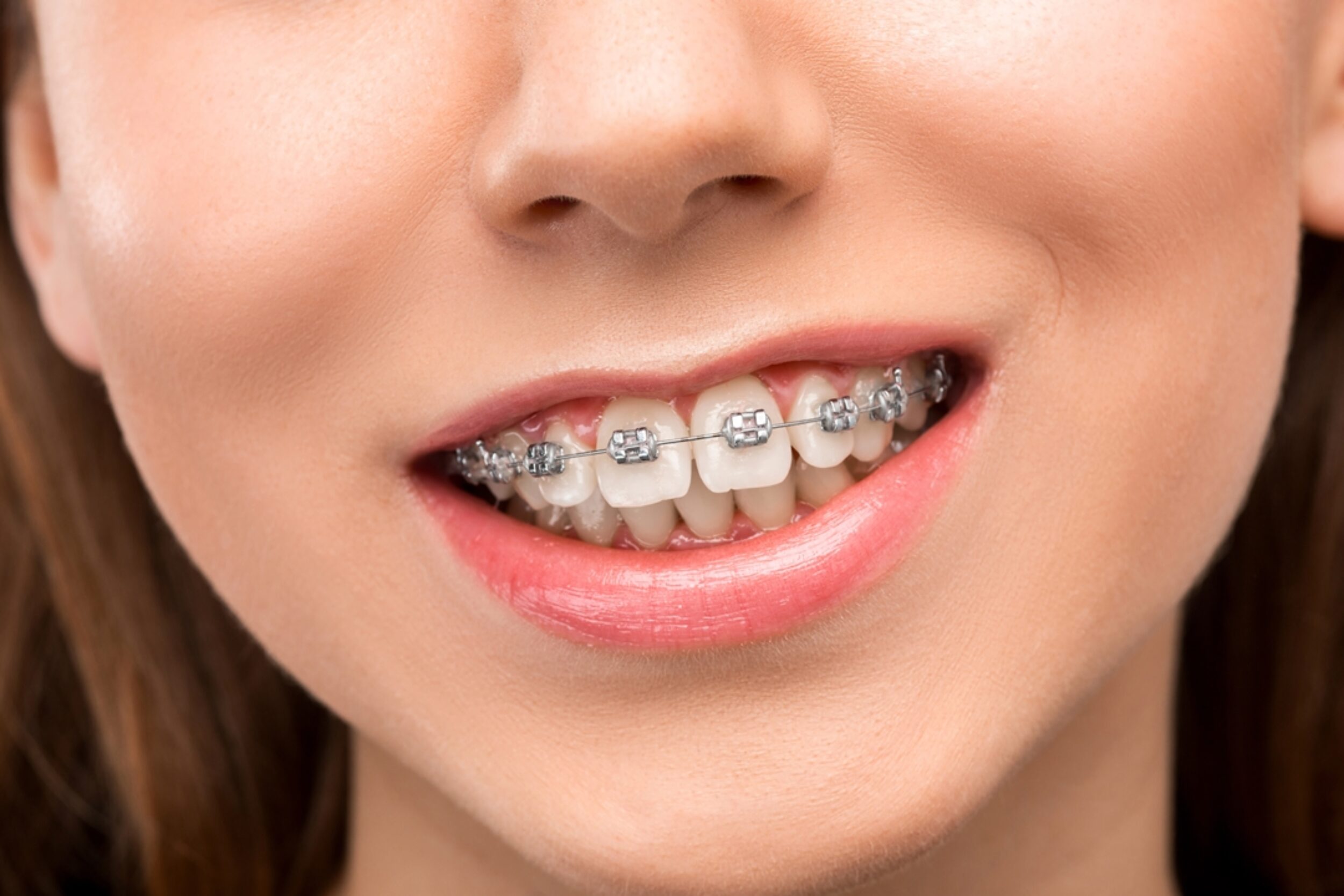 How Long Do Braces Hurt? The Orthodontic Place