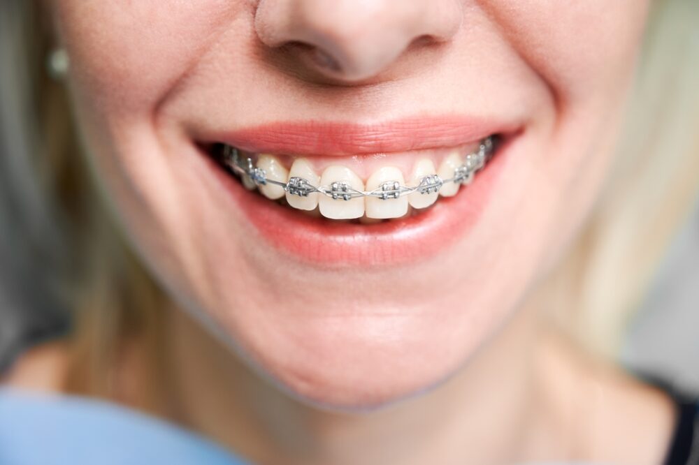 How Long Do Braces Hurt? The Orthodontic Place