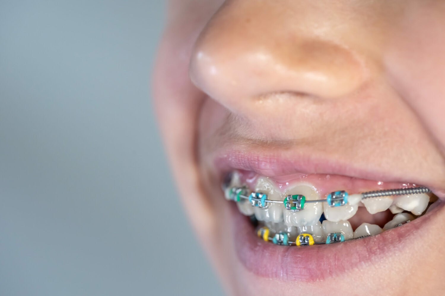 How to Put Rubber Bands On Braces The Orthodontic Place